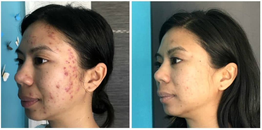 Acne Scaring Treatment