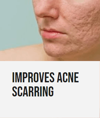 acne scaring