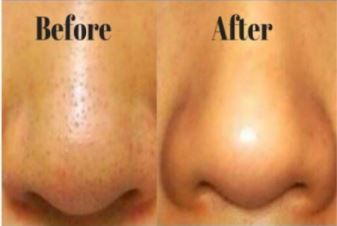 Large pore treatment