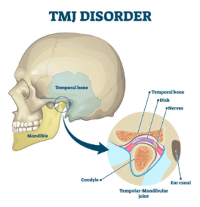 Jaw pain